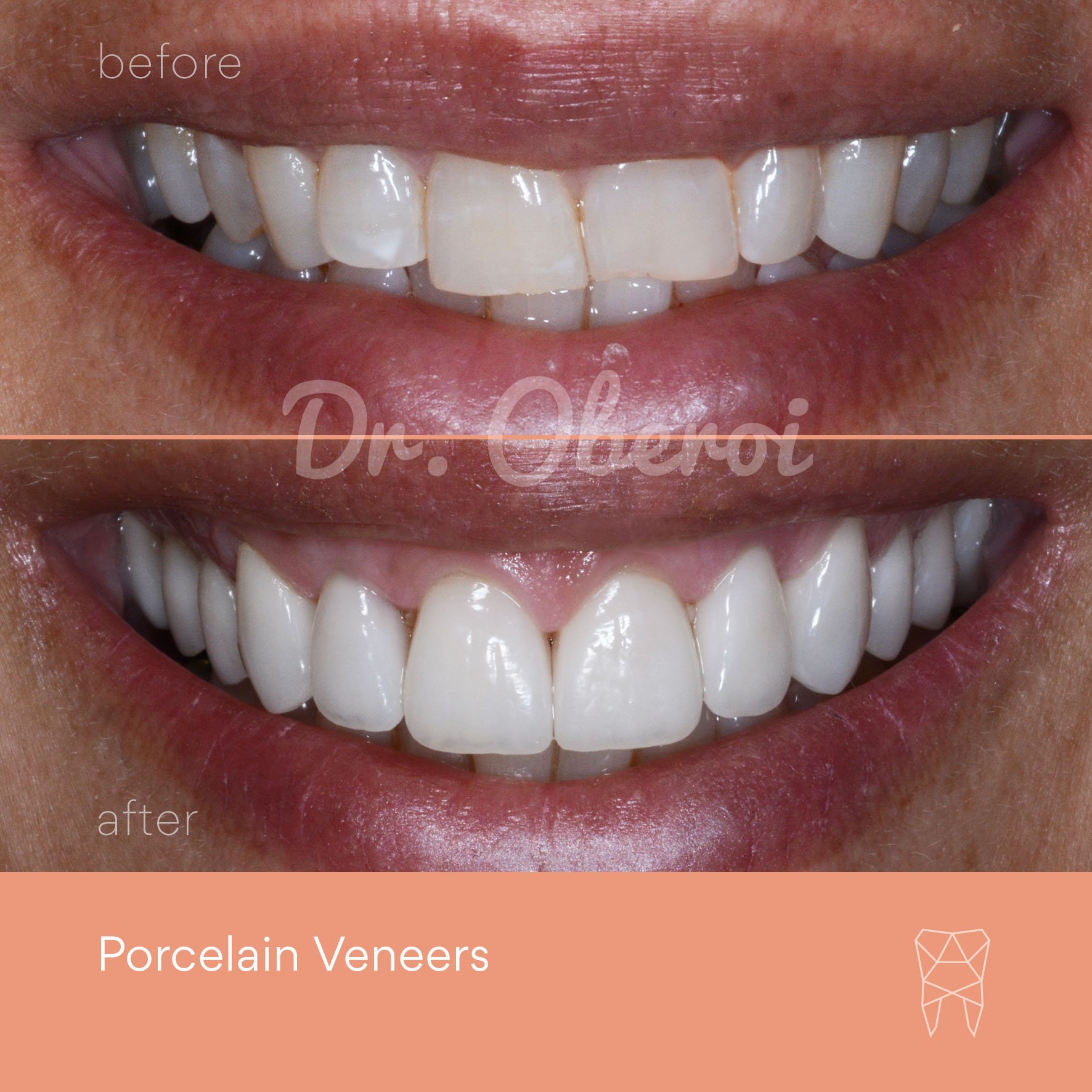 © PARAMOUNT DENTAL SYDNEY Porcelain Veneers before and after dentist 18.jpg