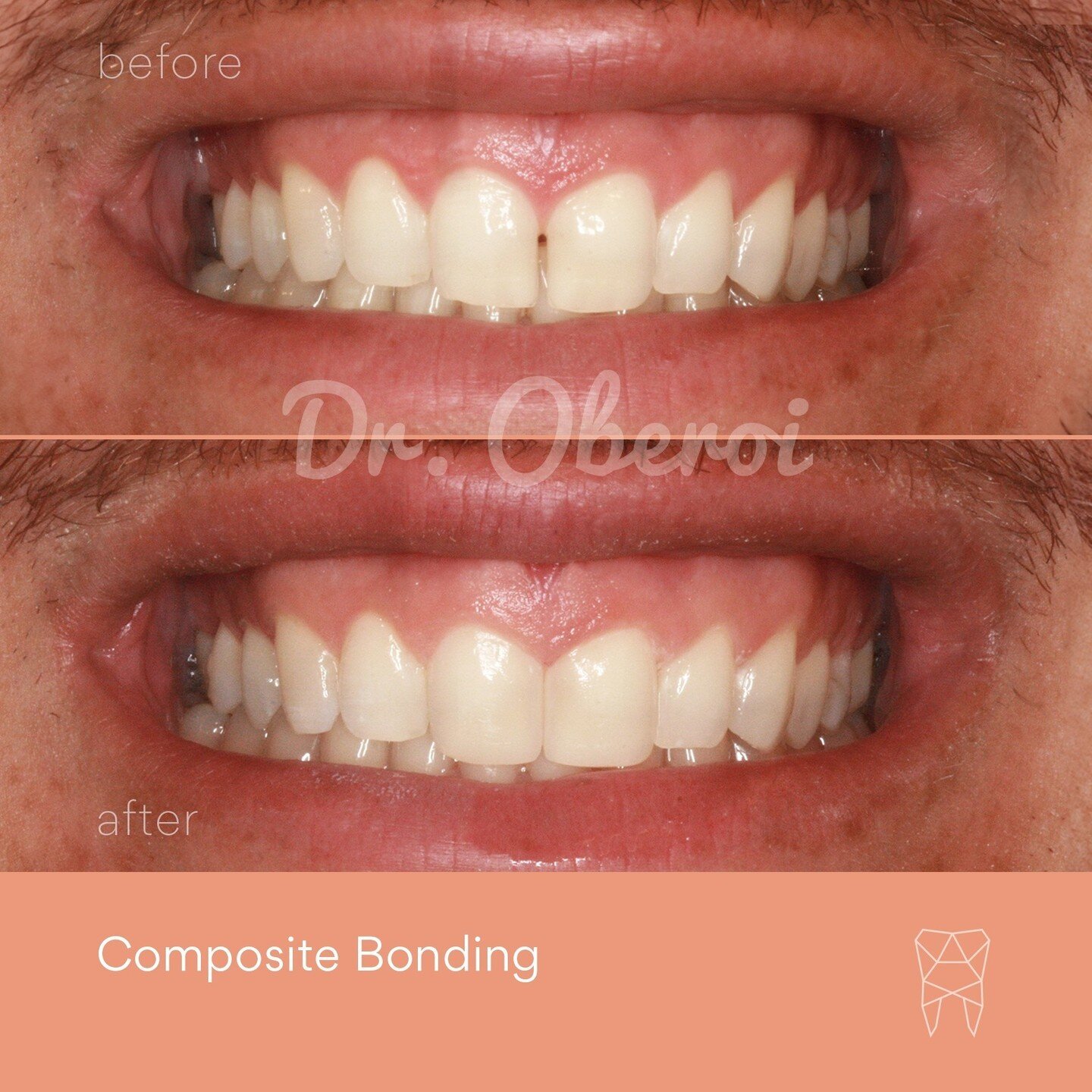 A fantastic result from a small and quick procedure! Dr Oberoi used composite bonding to close the gap in our patient's front teeth to create a beautiful uniform smile ✨⁠
⁠
🦷 Composite bonding⁠
⏰ Takes 20 minutes⁠
💲 from $150 per tooth⁠
⁠
Consideri