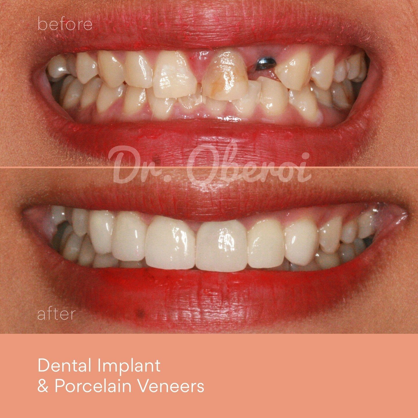 A brand new #smiletransformation from Dr Oberoi! ✨ With advancements in dental technology and materials, patients can achieve a natural-looking smile transformation that boosts confidence and improves overall oral health.⁠
⁠
🦷 Dental Implant &amp; P