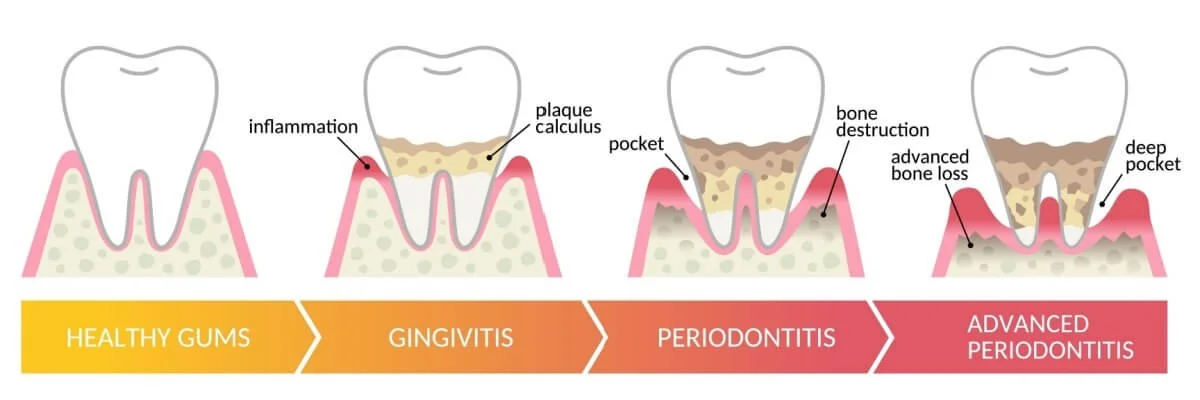 What Is Gum Disease And How To Cope With It — Paramount Dental Sydney