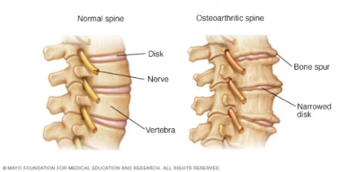 ans7_osteoarthritis-8col.jpg