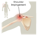 impingement.png