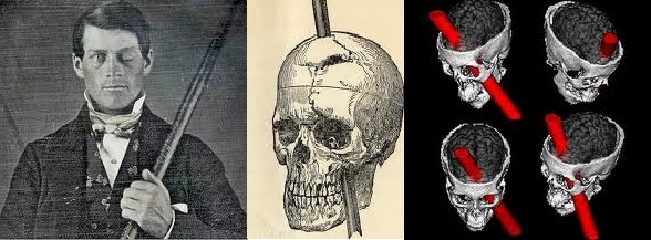 Phineas Gage: Daguerrotype, historic engraving and MRI. Warren Anatomical Museum, Harvard.
