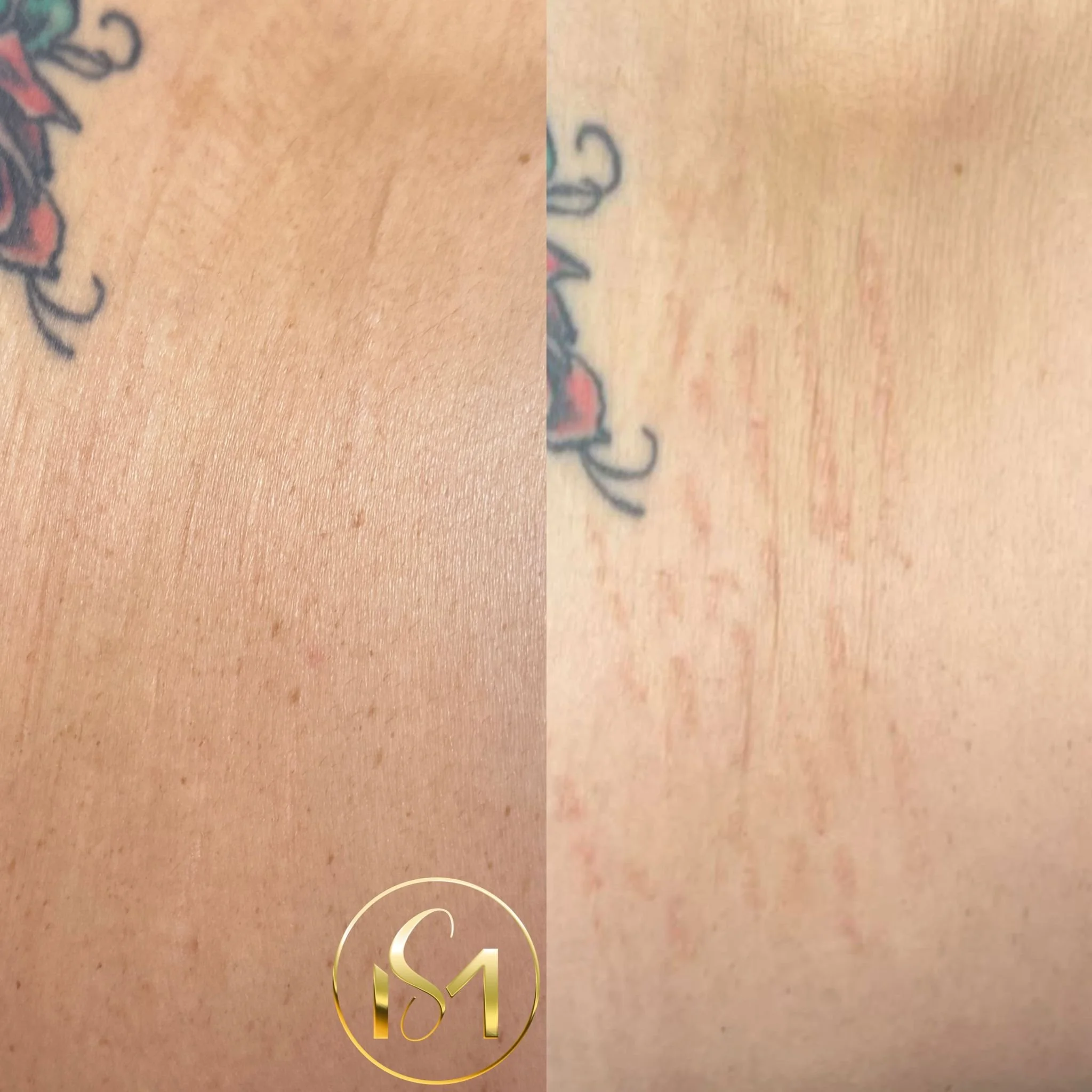 Tratamiento para desvanecer las estrias