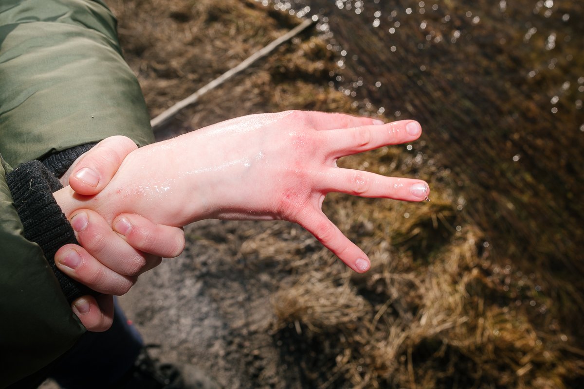 Red swollen hand of a boy playing in water