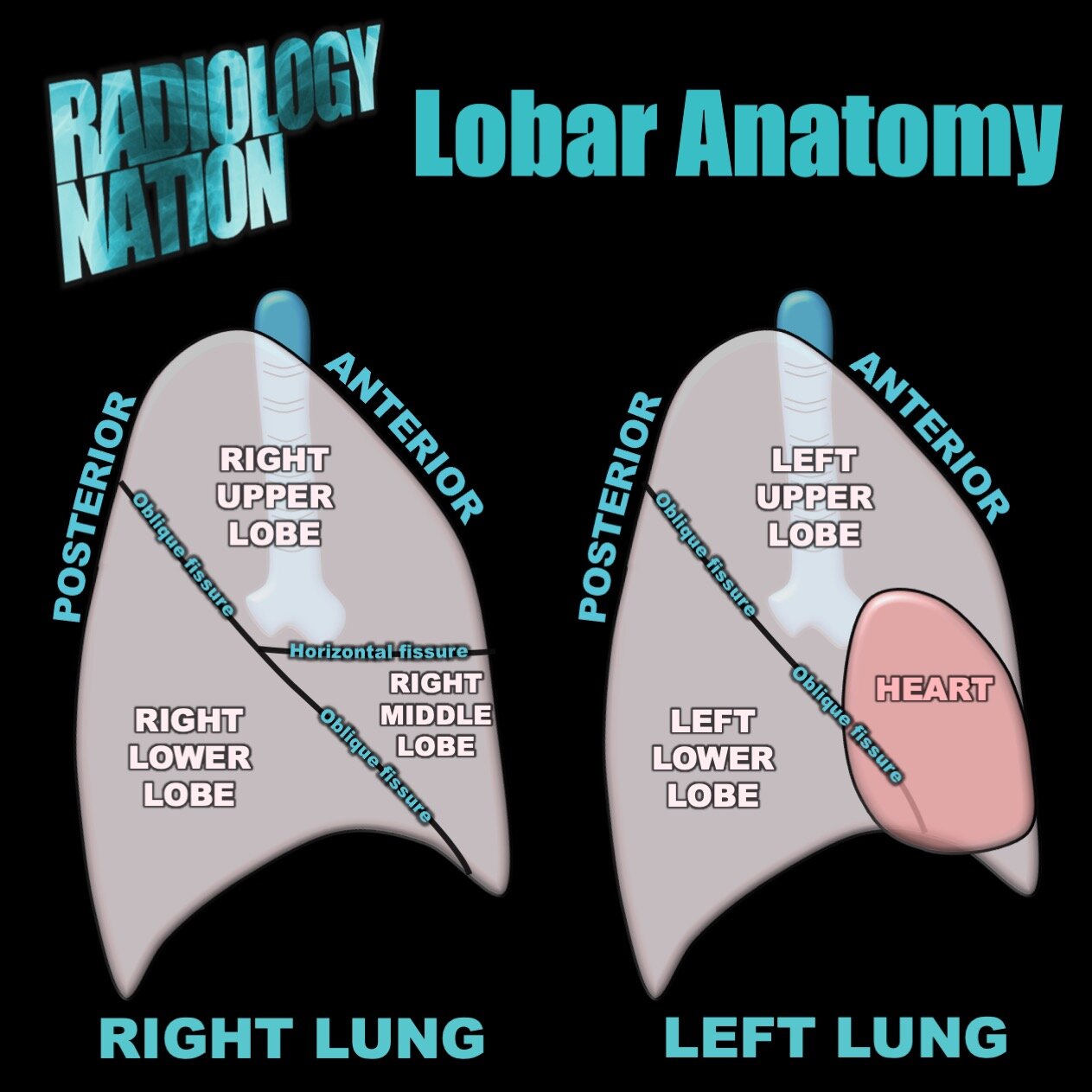 Left Pneumonia Review9.jpeg