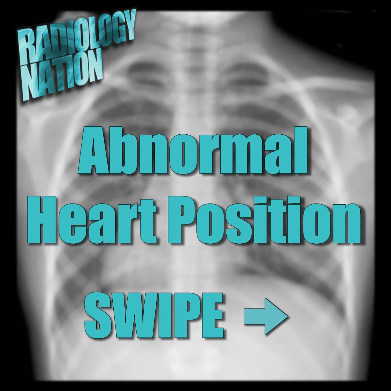 Situs inversus vs dextrocardia3.jpeg