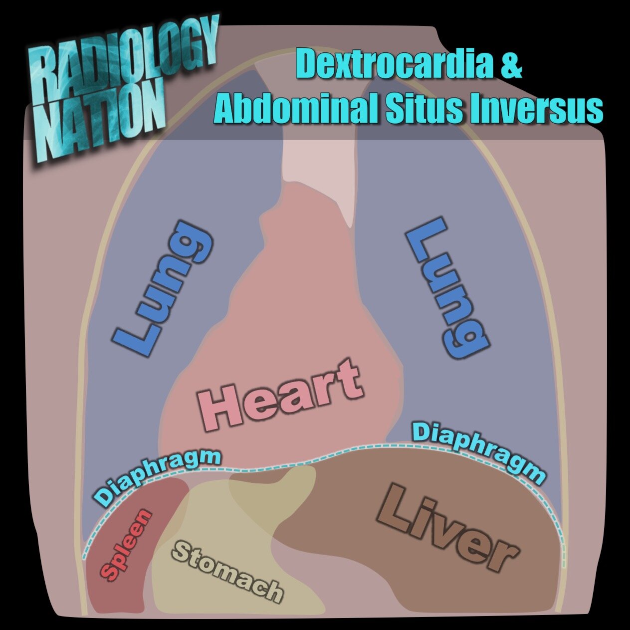 Situs inversus vs dextrocardia18.jpeg