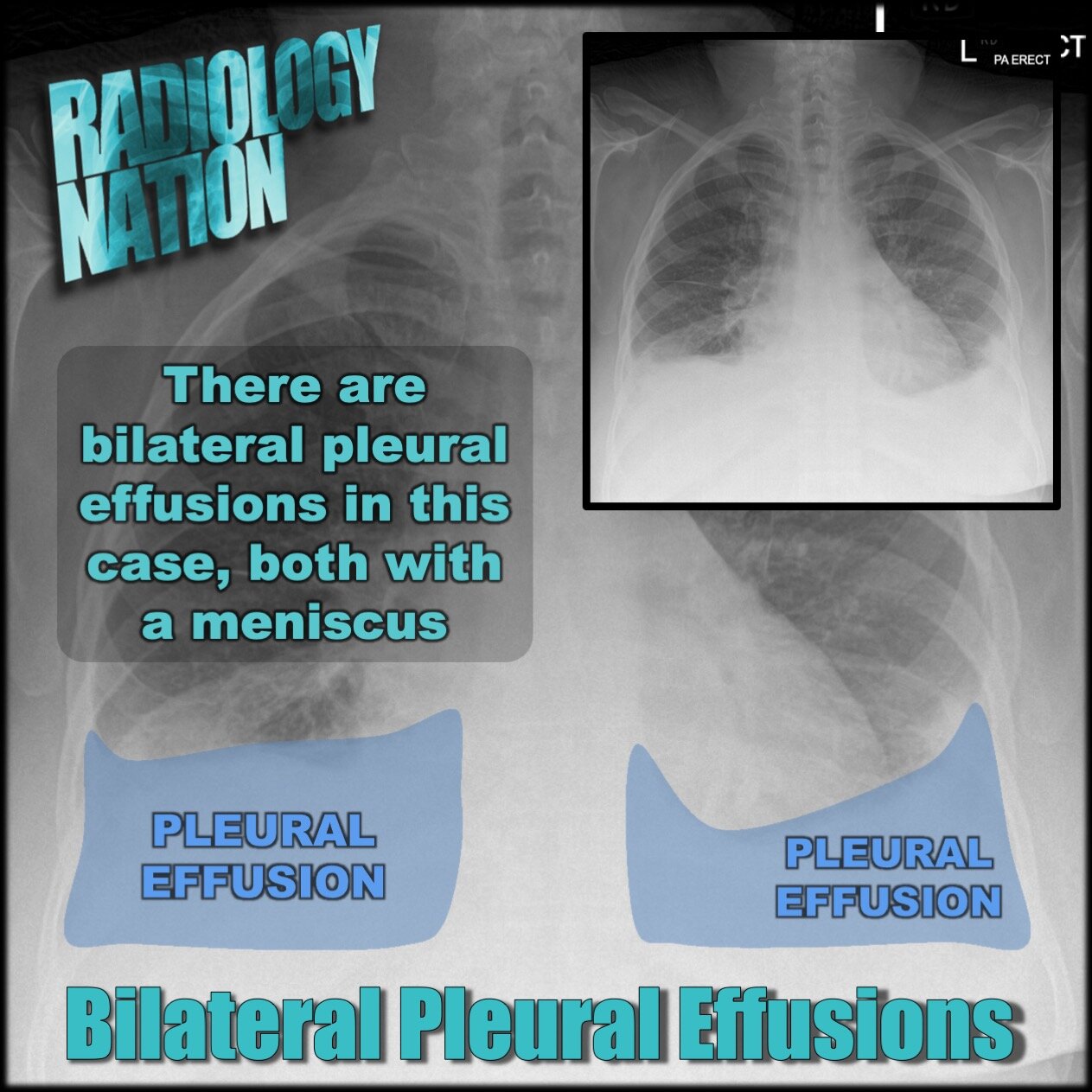 Pleural effusion vs hydropneumothorax13.jpeg