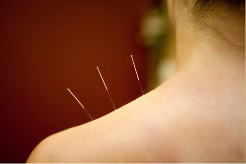 Acupuncture for Infertility