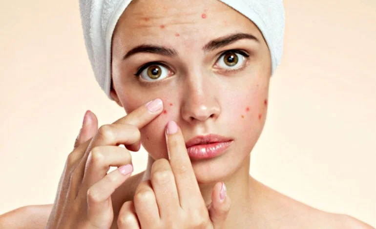 Picking acne will potentially leave you with scarring