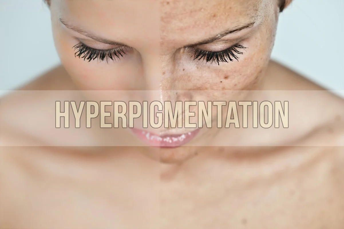 Hyperpigmentation.jpg