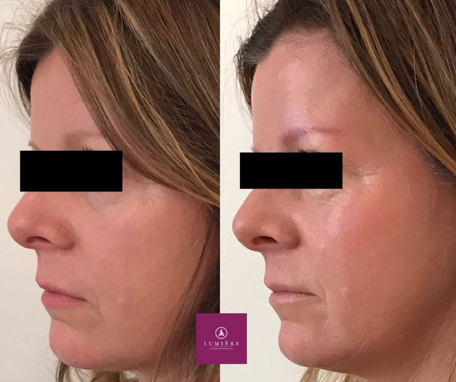 LUMIERE V Lifting B&A Pic 3 (2).jpg