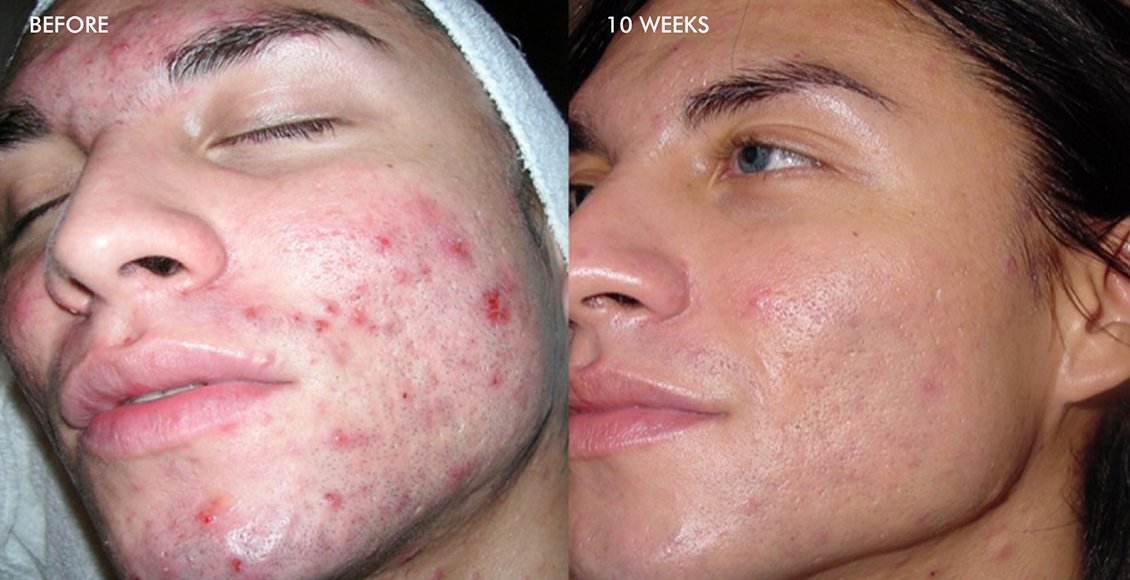 Dermalinfusion-Before-and-after-Acne-Patient-2-M6.jpg