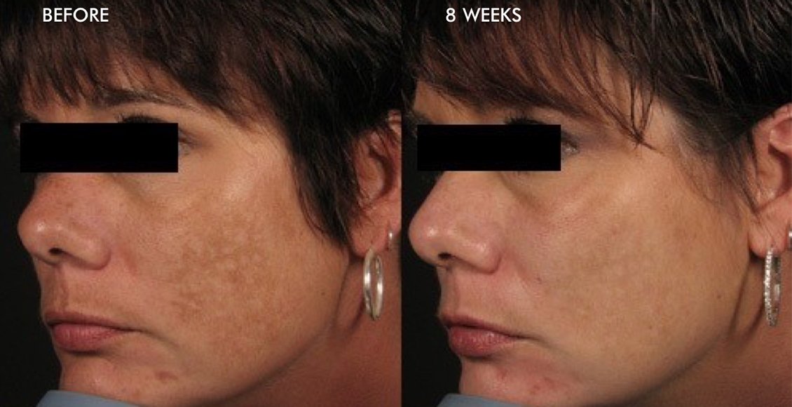 Dermalinfusion-Before-and-after-Melasma-Patient-M6.jpg