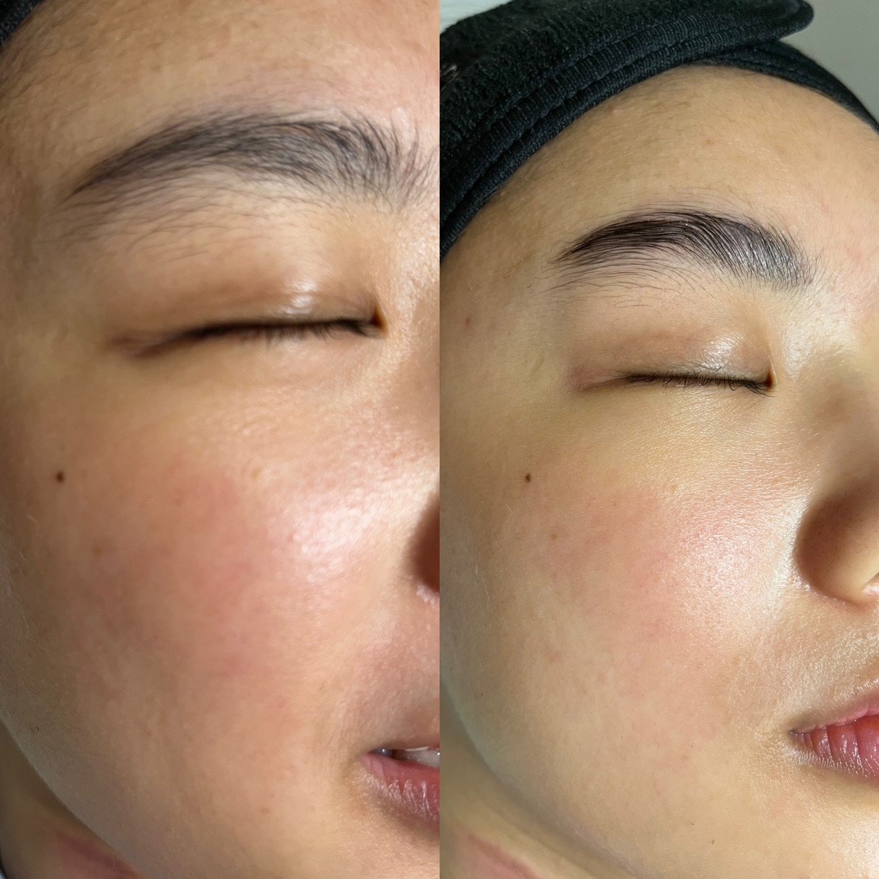  Best Facial Treatment Vancouver | Best Microneedling Vancouver 