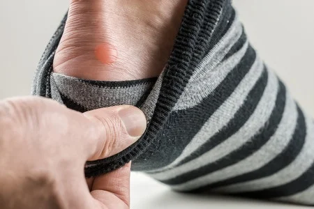 26762888_S_blister_fluid_heel_wool_sock_chafe_foot.jpg