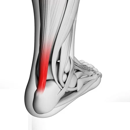 18448338_S_achilles_tendon_tendonitis.jpg