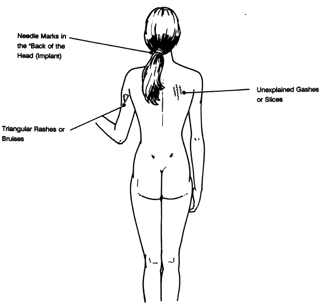 AbductionImplants.gif