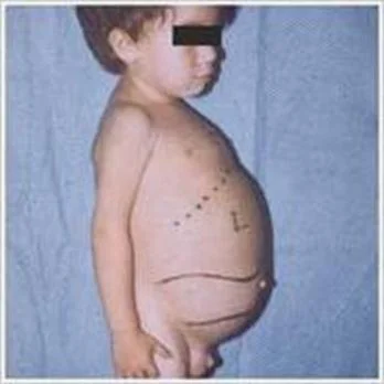 Child with Niemann-Pick Disease