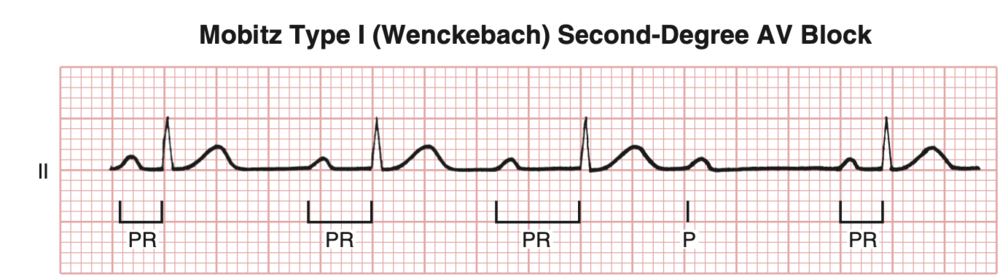 Extra Beat ECG. Second degree (Wenckebach). Av Blocks 3 degree ECG. Extra Beat ECG English. Av block remover сайт