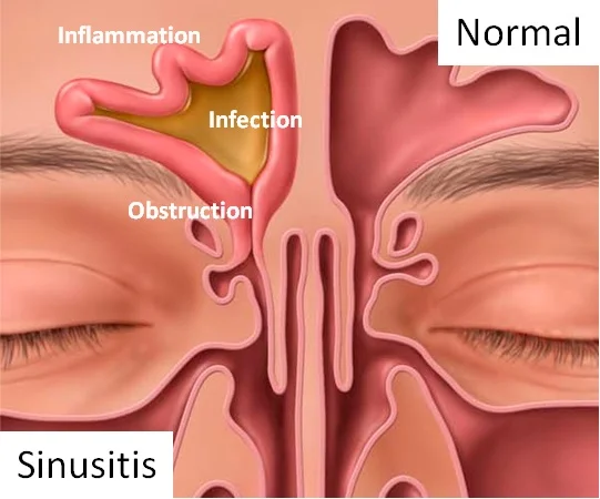 Sinusitis.jpg