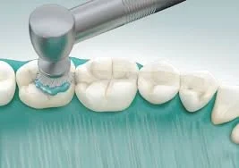 coronal polishing 2.jpg
