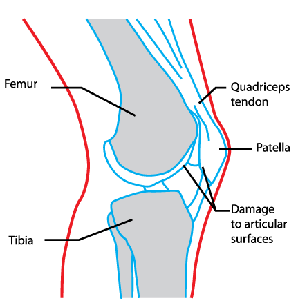 2016 Patellofemoral (Knee cap) consensus statements