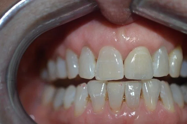 New cosmetic all-ceramic crown that has the natural characterization to blend it into her smile.