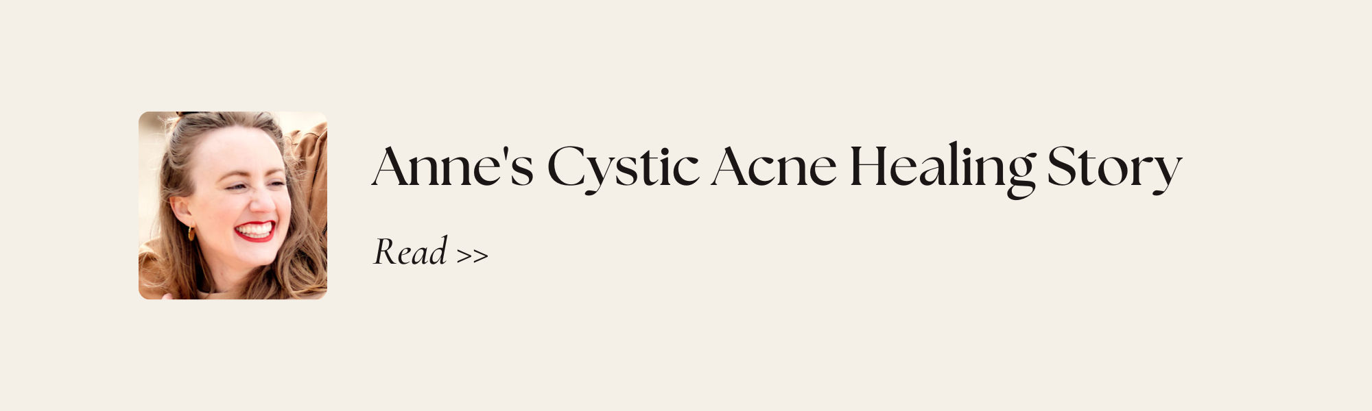 Read Anne's Acne Healing Story >> (Copy)