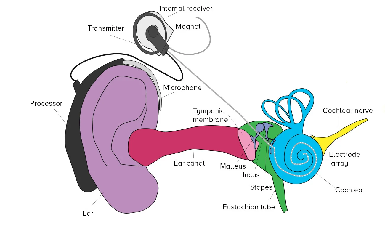 Cochlear-Implant-1300.jpg