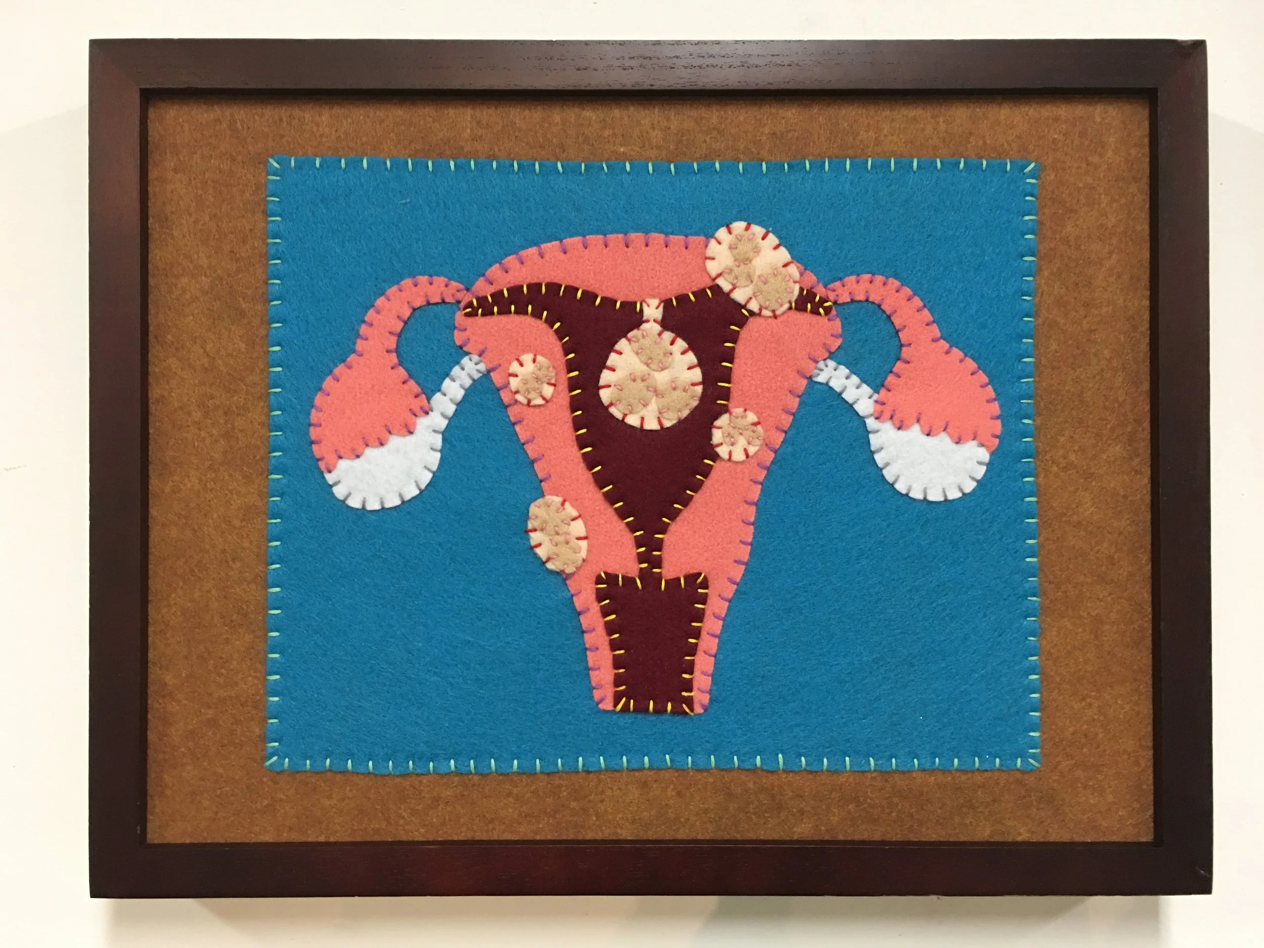 Uterine fibroids