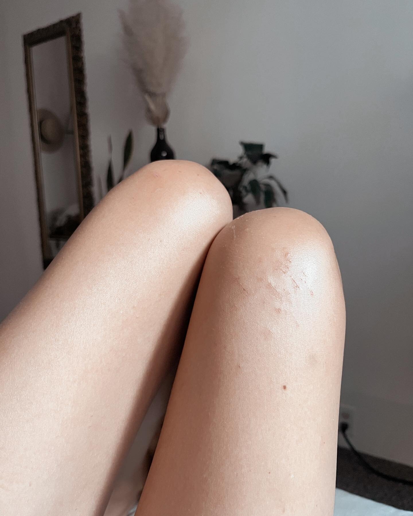 My knees have been in a perma state of being scratched up because I swim in the ocean and the tide throws me around and there are rocks I float over and scrape my skin and it keeps happening and I don&rsquo;t learn my lesson and it&rsquo;s okay becau