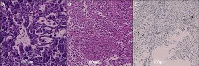 Tumors Perthera.jpg