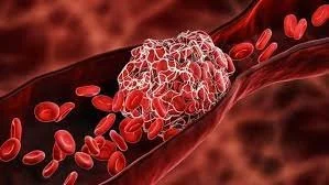 Caution - Men with Prostate Cancer Are More Likely to Develop Dangerous Blood Clots.