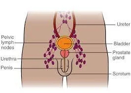 Differential Treatment Response for Hormone Sensitive Men with Nodal Metastases – Nodal Burden as a Prognostic Biomarker