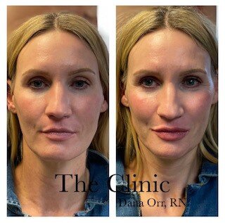 Sculptra in mid-face, Radiesse jawline/chin, Restylane Kysse lips 