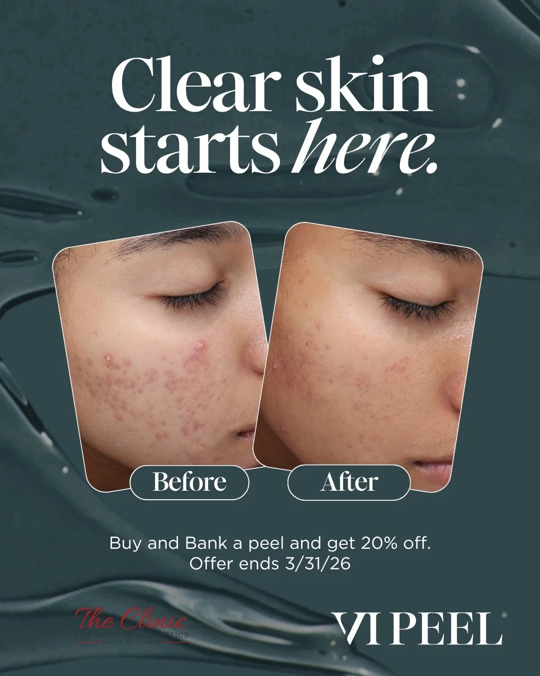 Real skin, real results. 💥

Can&rsquo;t make it in this month for the special? No problem! 😊 You can still take advantage by purchasing and banking your @vipeel now. This allows you to lock in the offer and use it later. It's perfect for after your