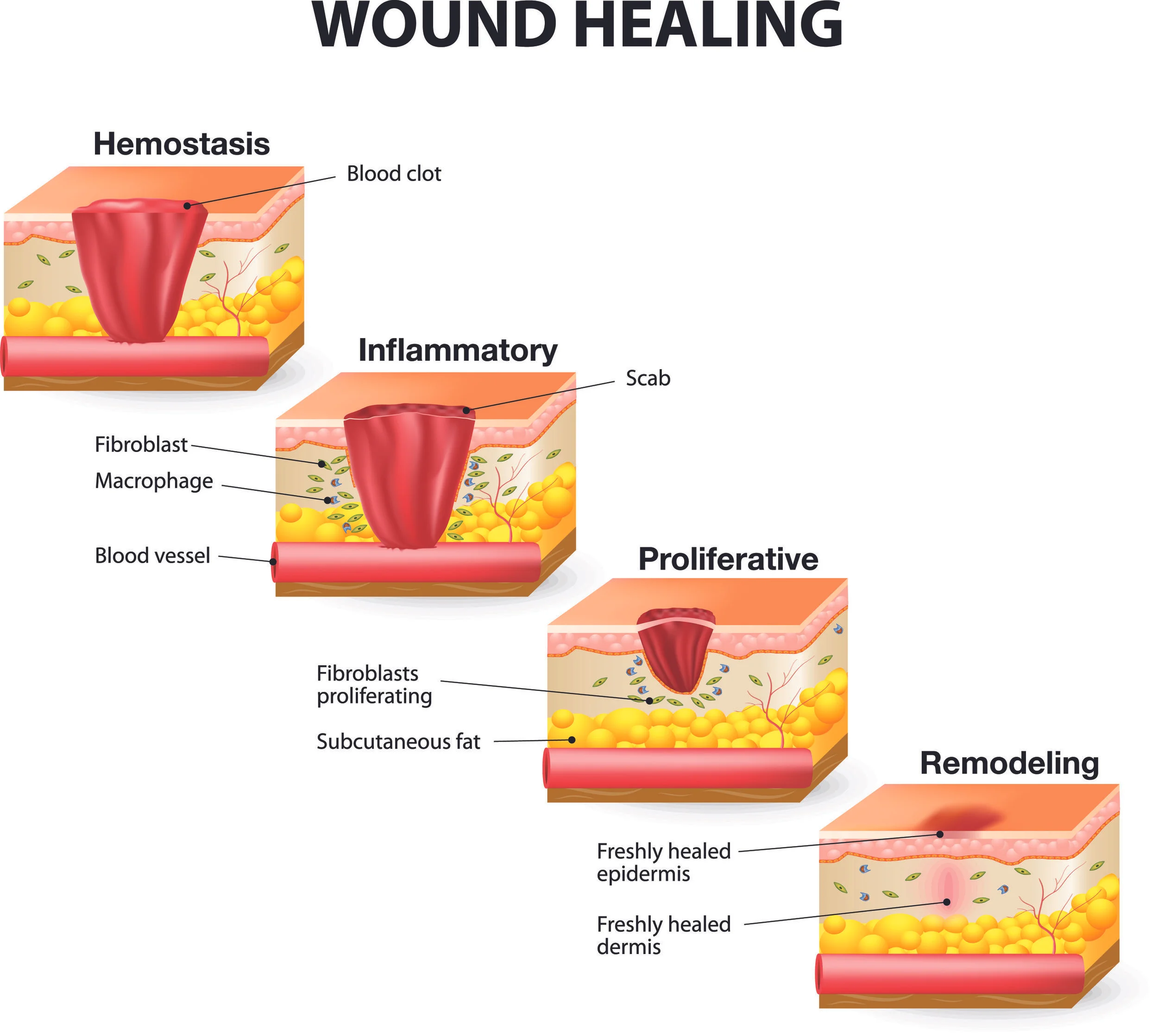 Stages of wound healing