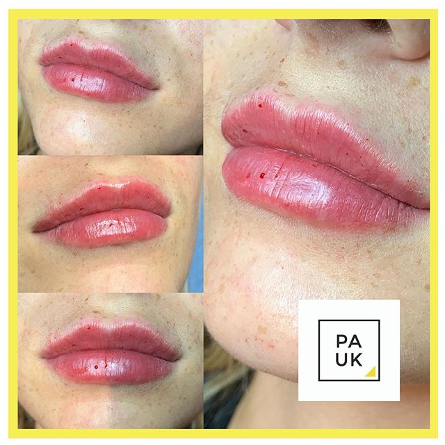 ▫😍👄 Beautiful Lips Alert 😍👄 ▫&mdash;&mdash;&mdash;&mdash;&mdash;&mdash;&mdash;&mdash;&mdash;&mdash;&mdash;&mdash;&mdash;&mdash;&mdash;&mdash;&mdash;&mdash;&mdash;&mdash;&mdash;&mdash;&mdash;&mdash;&mdash;&mdash;▫Here we have used 0.6ml boletero i