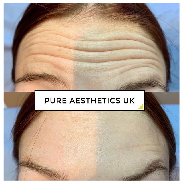 ▫️✨Anti-Wrinkle injections to the forehead for this gorgeous lady ✨▫️&mdash;&mdash;&mdash;&mdash;&mdash;&mdash;&mdash;&mdash;&mdash;&mdash;&mdash;&mdash;&mdash;&mdash;&mdash;&mdash;&mdash;&mdash;&mdash;&mdash;&mdash;&mdash;&mdash;&mdash;&mdash;&mdash