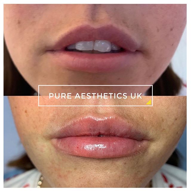 ▫❤️ 👄 Beautiful Lip Enhancement results on my gorgeous client 👄❤️▫&mdash;&mdash;&mdash;&mdash;&mdash;&mdash;&mdash;&mdash;&mdash;&mdash;&mdash;&mdash;&mdash;&mdash;&mdash;&mdash;&mdash;&mdash;&mdash;&mdash;&mdash;&mdash;&mdash;&mdash;&mdash;&mdash;