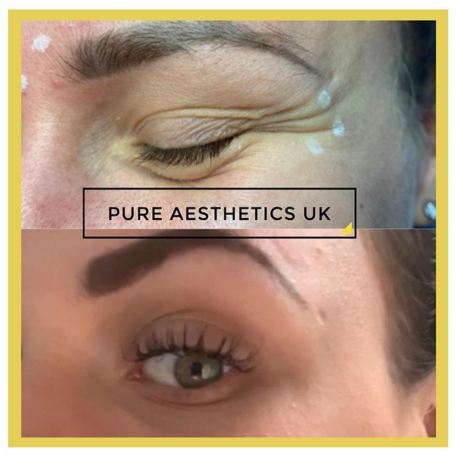 ▫✨ Loving these results on my beautiful client banishing those crows feet, using Anti-wrinkle injections 😍🙌🏻💉✨ ▫&mdash;&mdash;&mdash;&mdash;&mdash;&mdash;&mdash;&mdash;&mdash;&mdash;&mdash;&mdash;&mdash;&mdash;&mdash;&mdash;&mdash;&mdash;&mdash;&