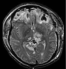 Brain Herniation