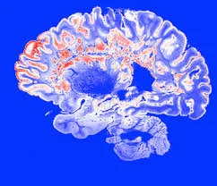 Multiple Sclerosis