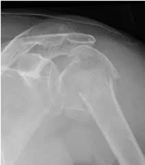 Proximal Humerus Fracture Treatment