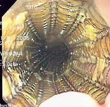 Esophageal dilatation After Nissan fundoplication