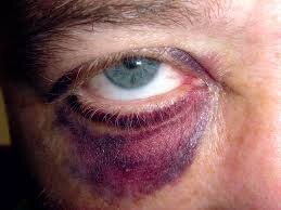 Soft tissue facial contusions