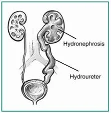 Hydronephrosis