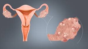 Polycystic Ovary Syndrome (PCOS)